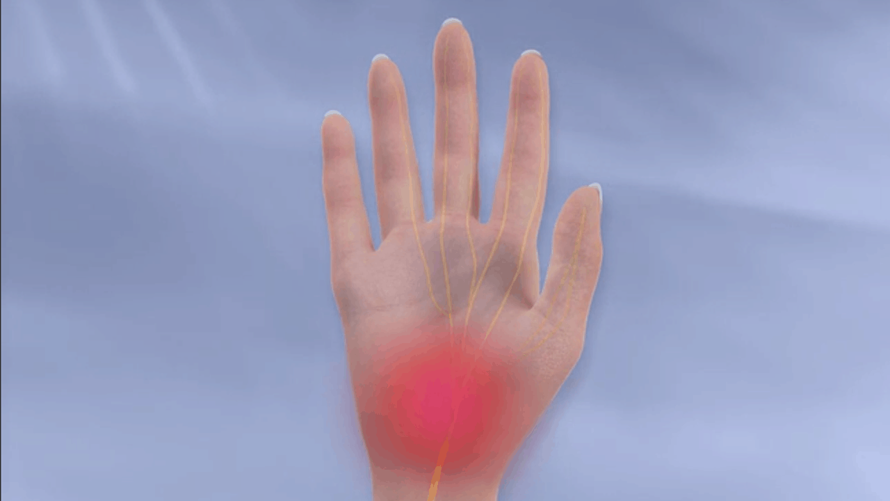 carpal tunnel syndrome