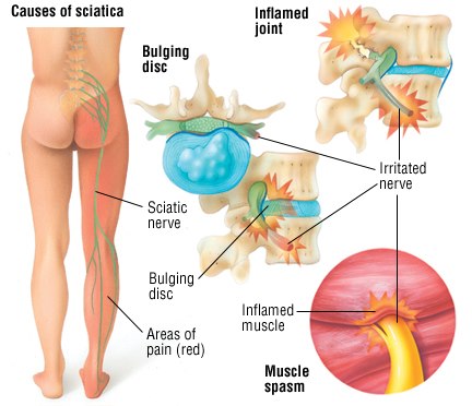 Sciatic Pain Relief - Sciatica Nerve Pain Relief - Sciatica Nerve  Inflammation Reducer - No side effects