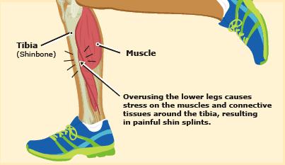 Shin Splints: What causes pain and how to prevent it - Santa Clara Chiro