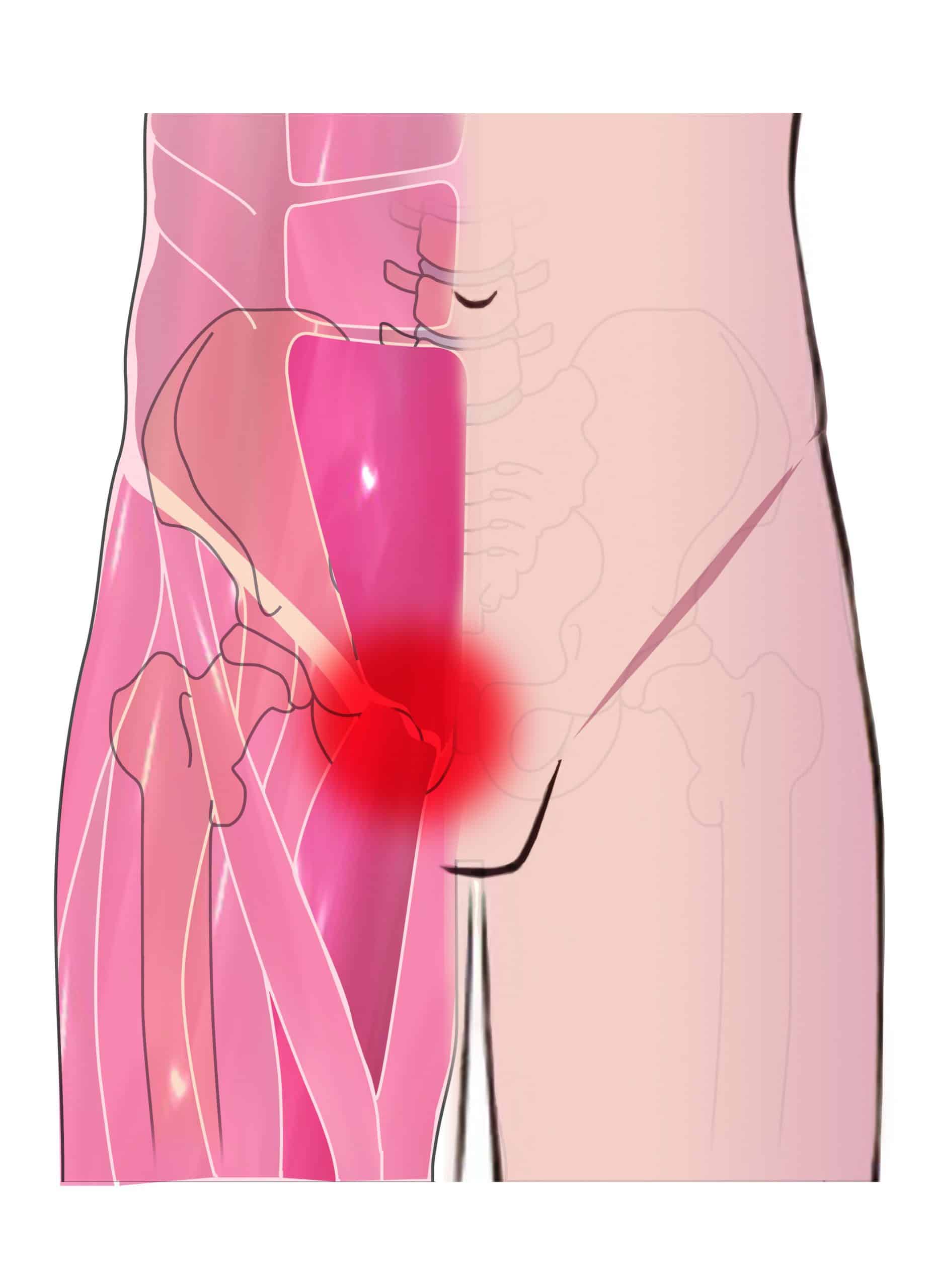 ATHLETIC PUBALGIA - 📝A sports hernia is a painful, soft tissue