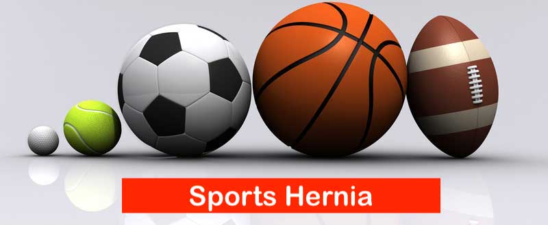 SPORT: A new framework for discussing sports hernias from the